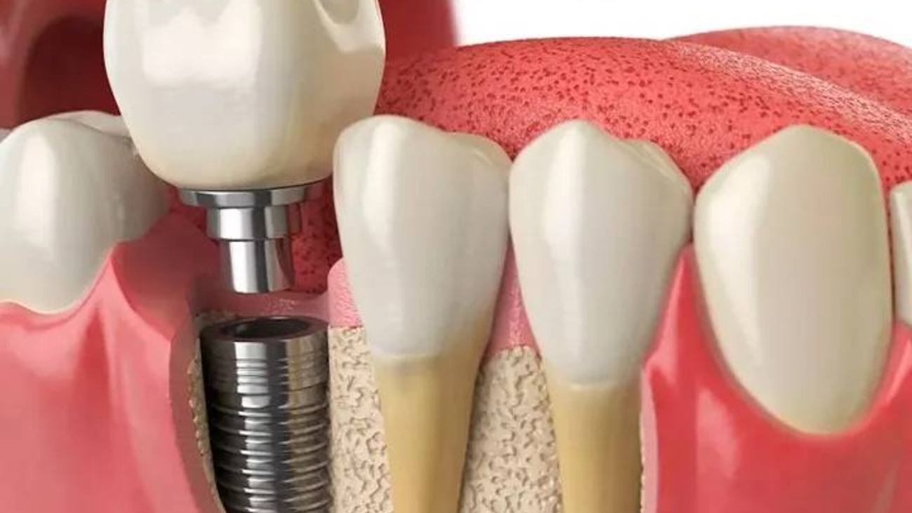 RICHSA_Implantes-Caracteristicas-y-Ventajas