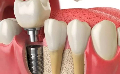 RICHSA_Implantes-Caracteristicas-y-Ventajas